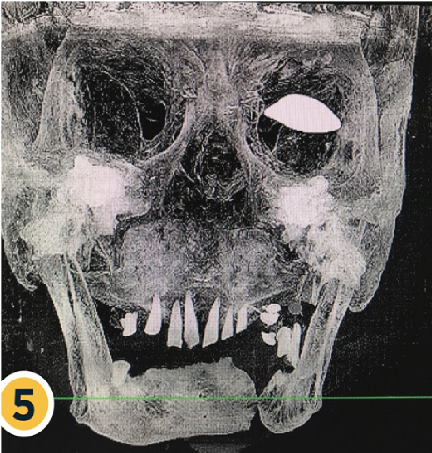 A tomografia Computadorizada da Face mostrando. a presença de 9 dentes e Fratura Oblíqua da mandíbula (Foto: Eder Huttner, Bruno Candeias, Edison Huttner.)