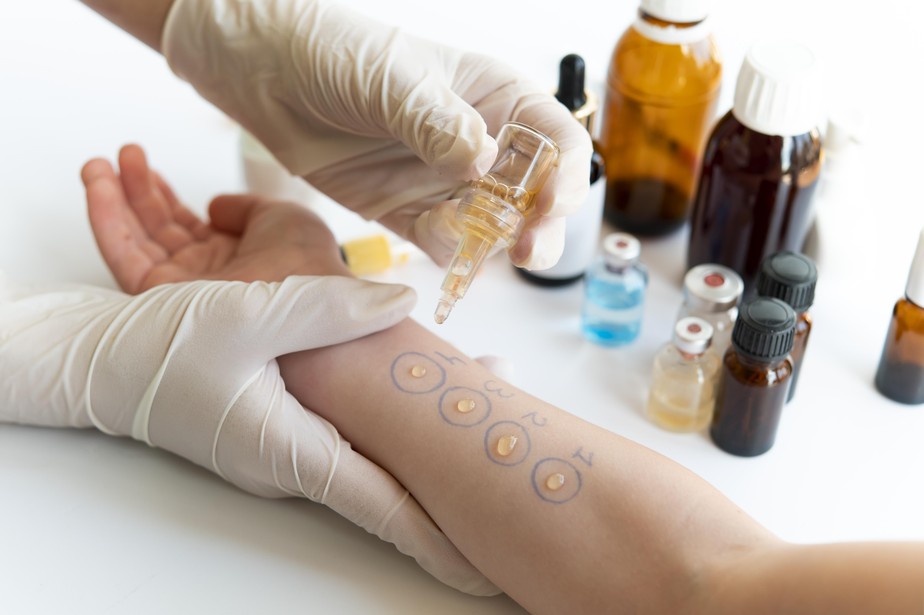 Teste de alergias é feito com extratos sobre a pele