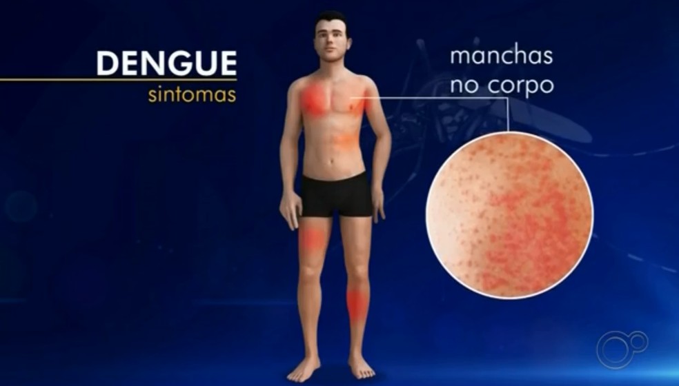 Manchas pelo corpo é um dos sintomas da dengue — Foto: Reprodução/TV TEM