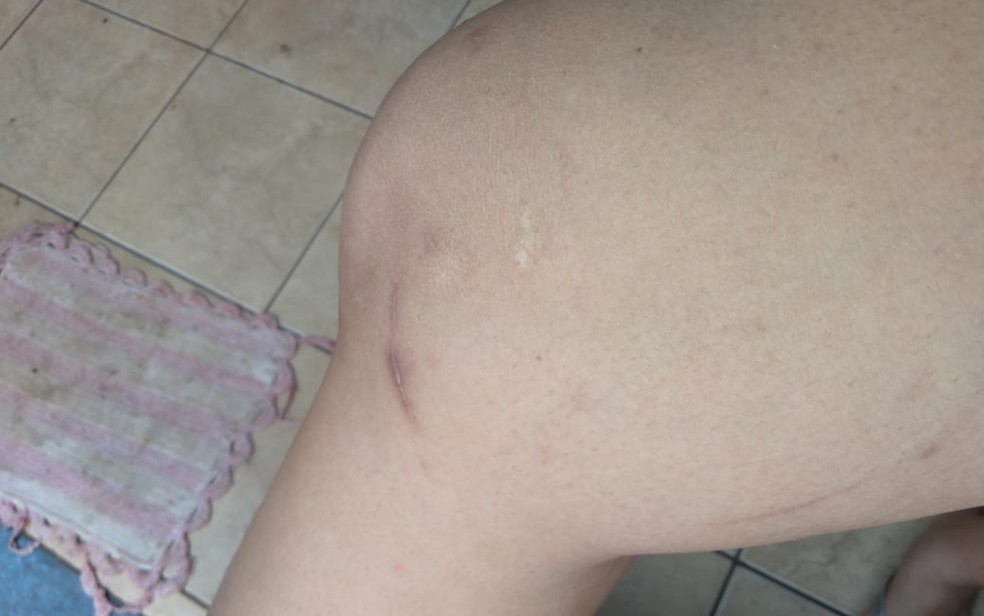 Cicatrizes na perna de Shakira Costa, em Rio Verde, Goiás — Foto: Shakira Costa/Arquivo pessoal