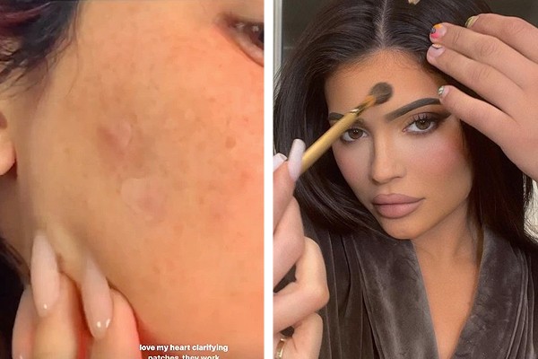 Kylie Jenner surprised fans by showing her real skin, with pimples and all, in an Instagram post (left) (Photo: Playback / Instagram)