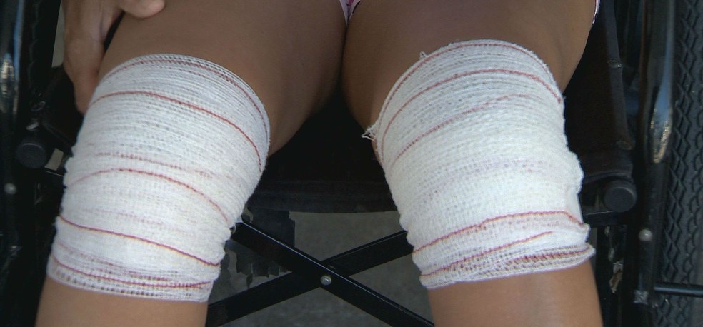 A manicure Maria Aparecida Vale contou que teve os dois joelhos operados, apÃ³s o primeiro procedimento ser feito no lado errado â€” Foto: ReproduÃ§Ã£o/TV IntegraÃ§Ã£o