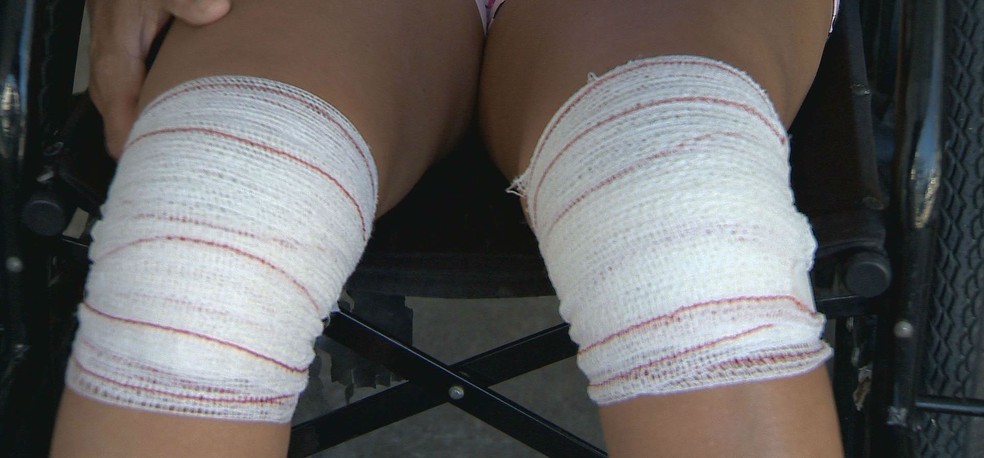 A manicure Maria Aparecida Vale contou que teve os dois joelhos operados, após o primeiro procedimento ser feito no lado errado — Foto: Reprodução/TV Integração