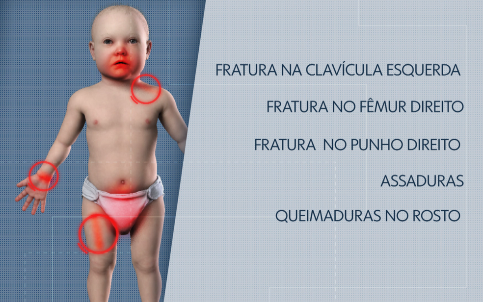 Bebês de 6 meses foi diagnosticada com fraturas, assaduras e queimaduras supostamente praticadas pelos pais, no DF — Foto: TV Globo/Reprodução