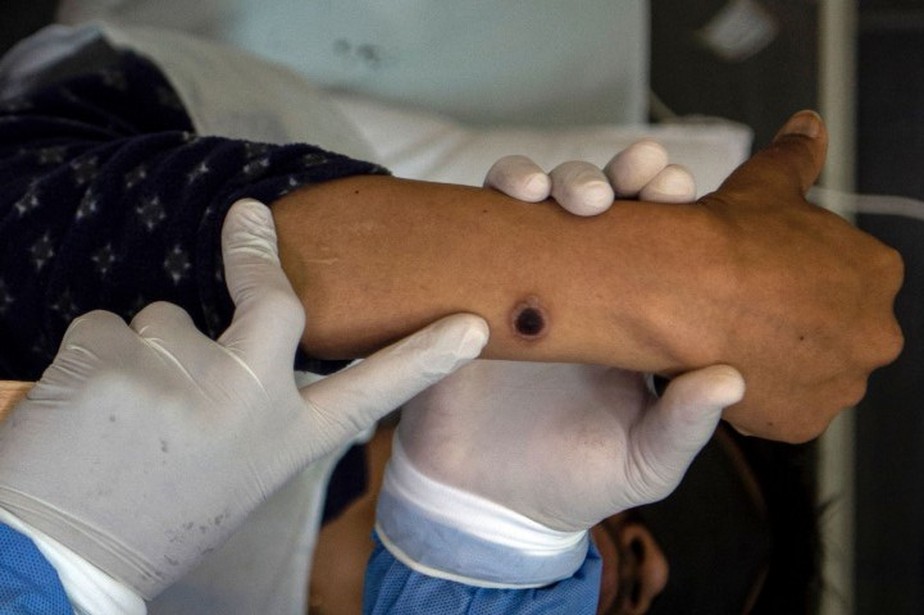 Paciente com monkeypox é examinado no hospital Arzobispo Loayza em Lima, no Peru