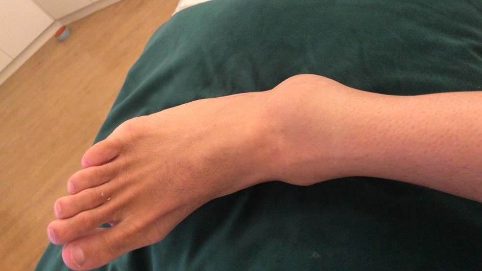 Falcão mostra tornozelo inchado após torção em pelada com amigos  — Foto: Arquivo Pessoal/Falcão 