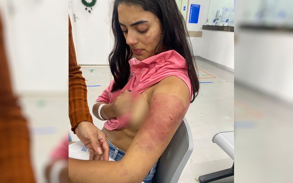 Isabella Lacerda ficou com hematomas após ser agredida pelo namorado, em Goiânia, Goiás — Foto: Arquivo pessoal/Isabella Lacerda