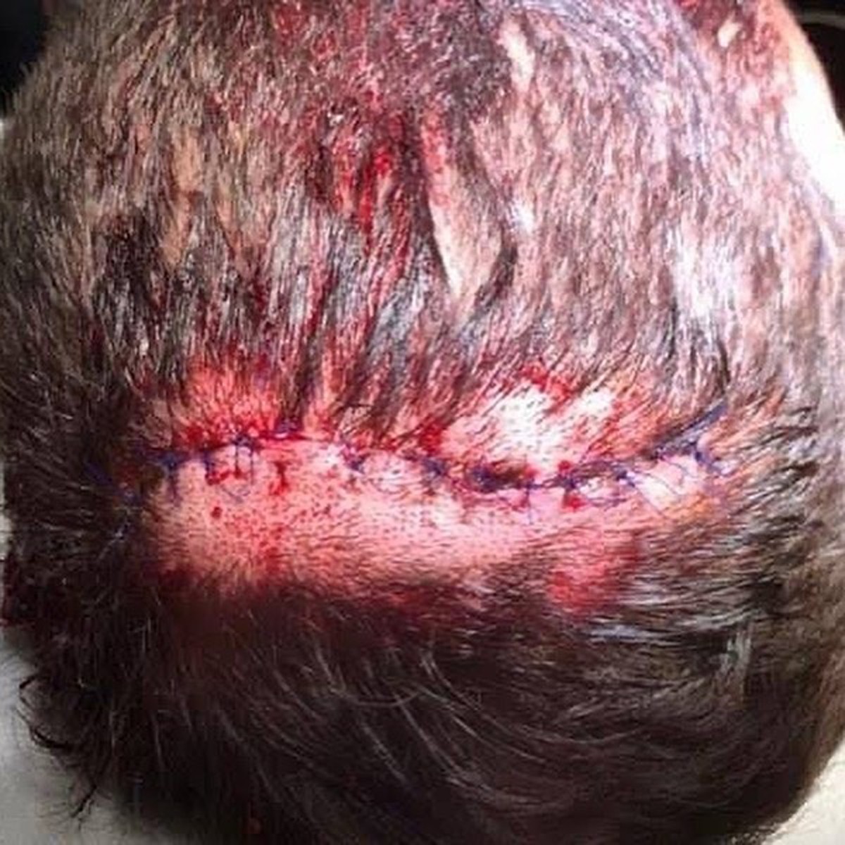 Pedro Scooby mostra cicatriz de acidente (Foto: Reprodução Instagram)