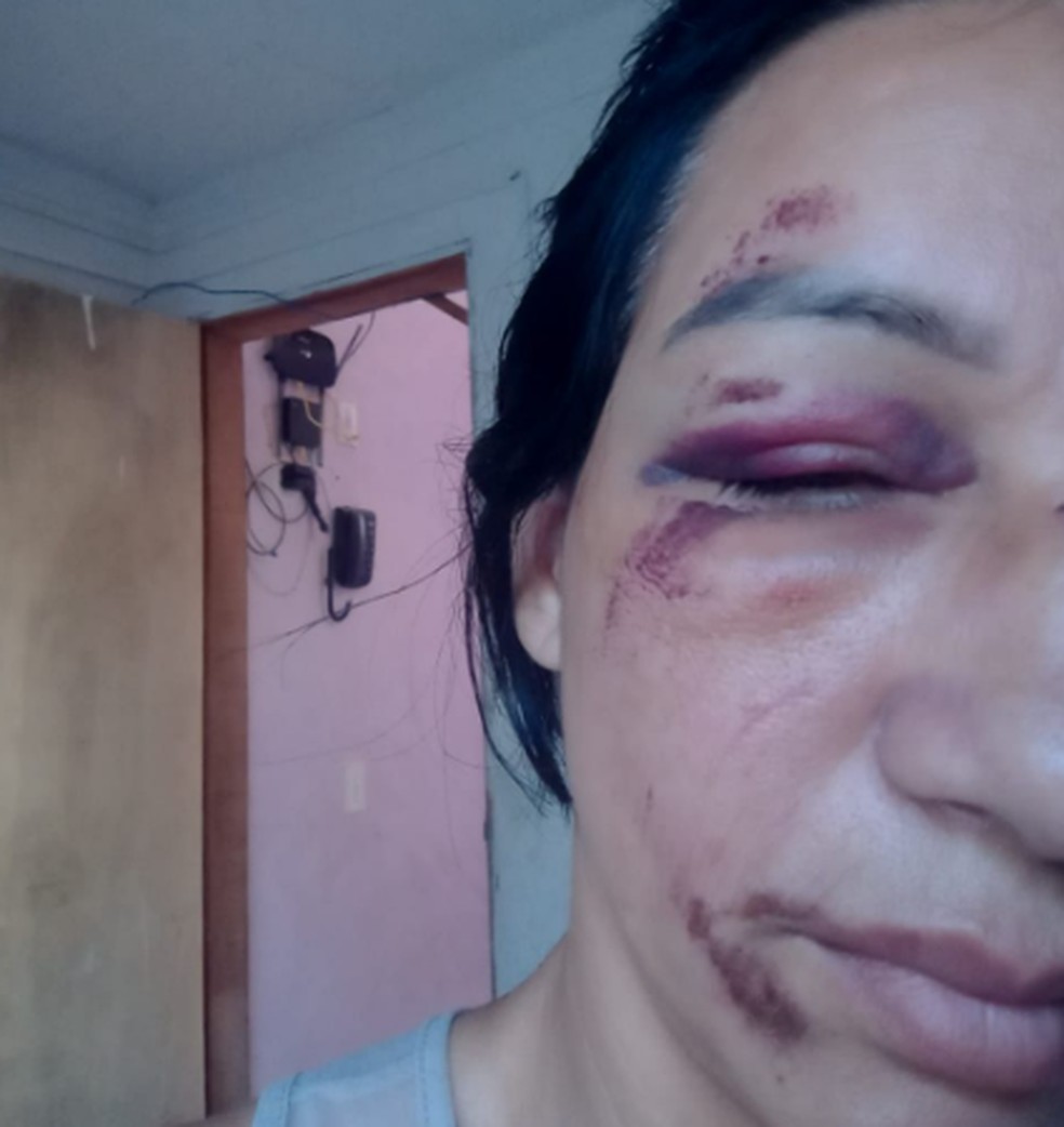 Ciclista atropelada por caminhonete em Fortaleza ficou com vários hematomas no rosto. — Foto: Arquivo pessoal 