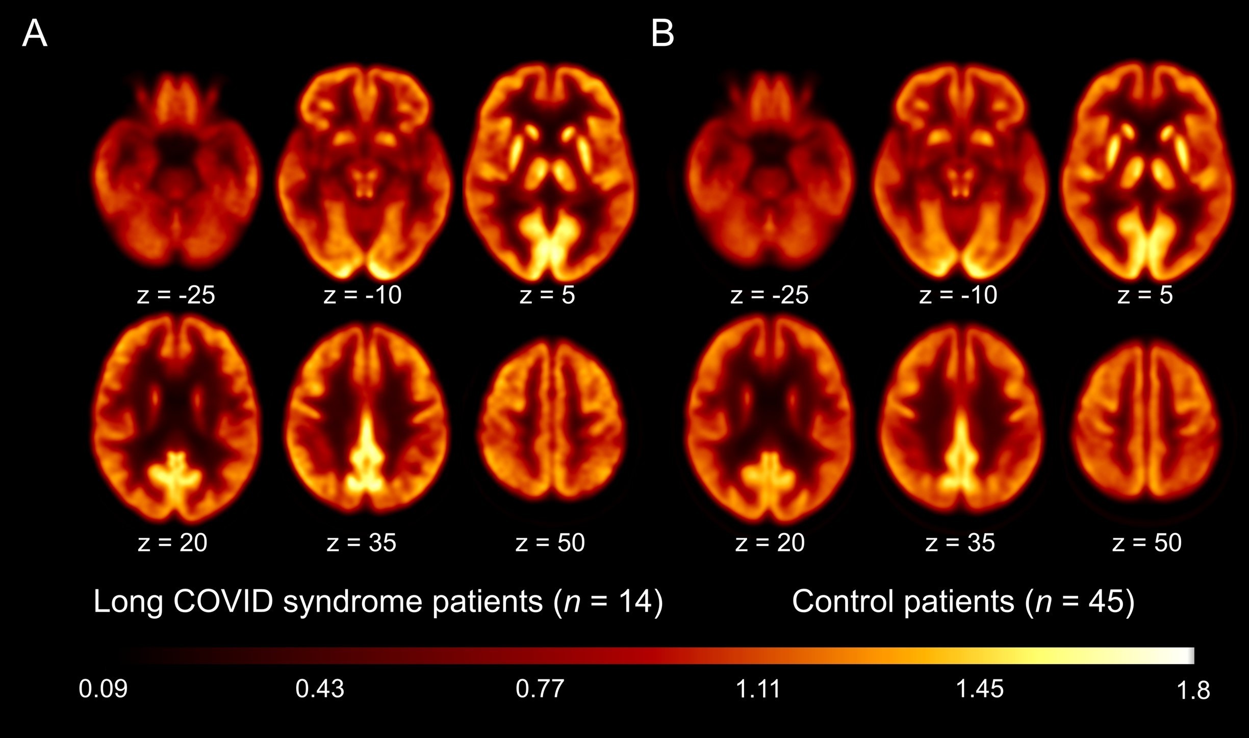 Covid longa seria consequência de fadiga, não de disfunção cerebral (Foto: Reprodução/The Journal of Nuclear Medicine)
