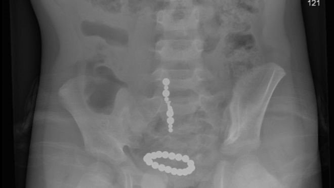 Menino teve o intestino removido após engolir bolinha magnéticas (Foto: Reprodução/CAPT)
