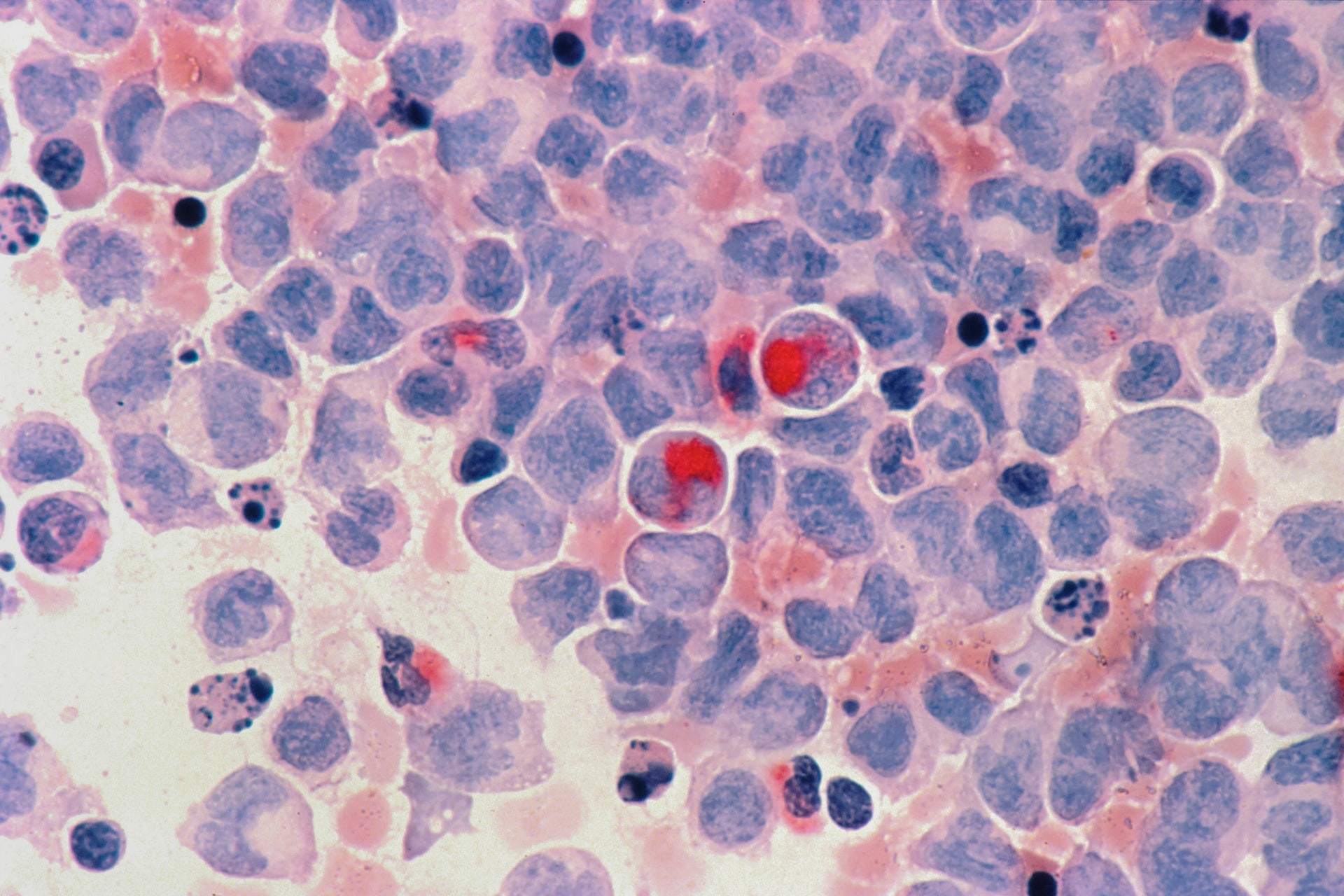Células com leucemia mielocítica aguda, tipo de câncer do sangue e da medula óssea (Foto: National Cancer Institute )