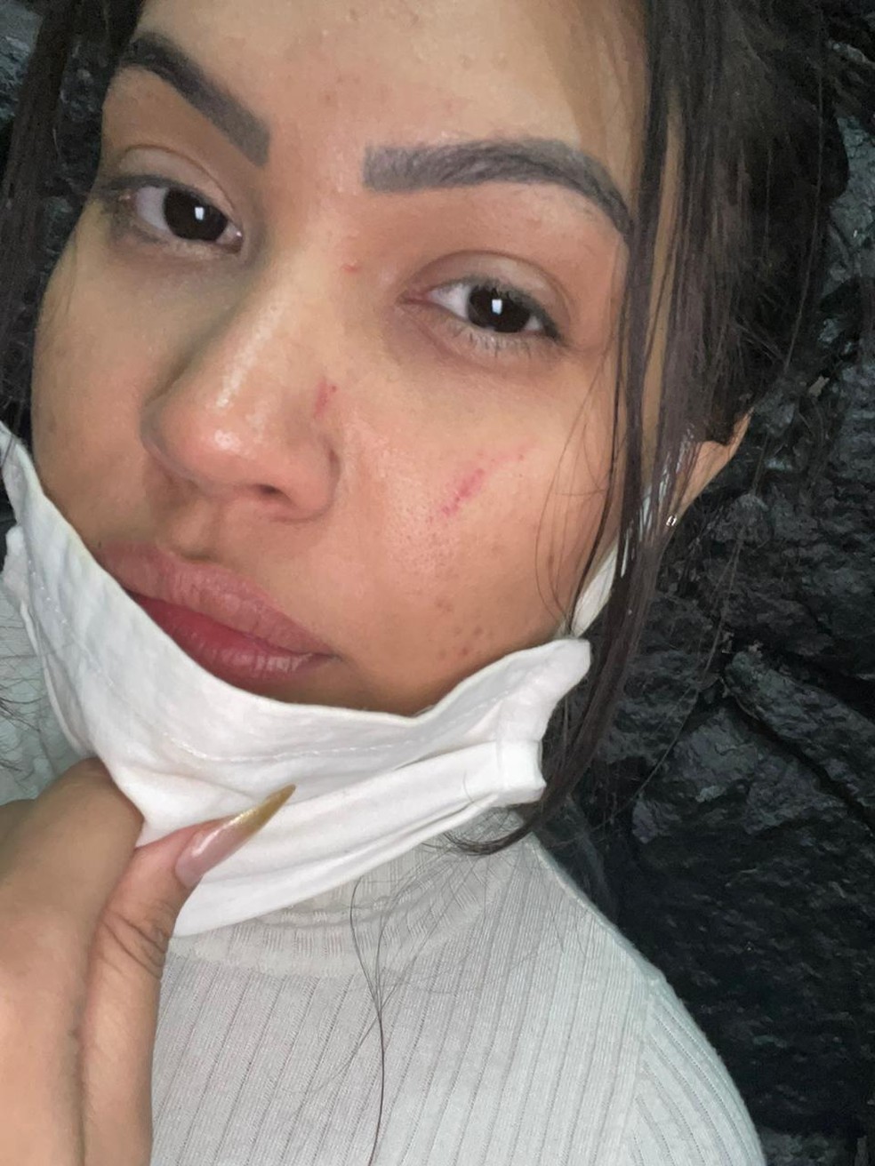 Ayarla ficou com o rosto arranhado depois de ser agredida por vizinhas — Foto: Ayarla Souza/Arquivo Pessoal
