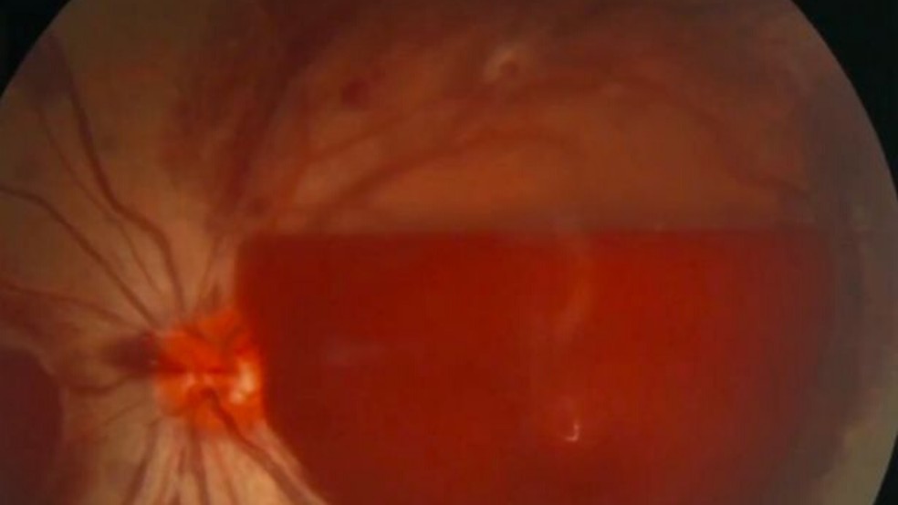 Manchas de sangue obstruíam a visão da paciente — Foto: Reprodução/FoxNews.com