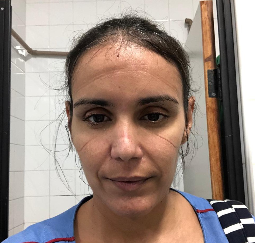 Médica Mariana Chaves se voluntariou para atuar na área do coronavírus. No rosto as marcas dos equipamentos de proteção usados por ela — Foto: Arquivo pessoal