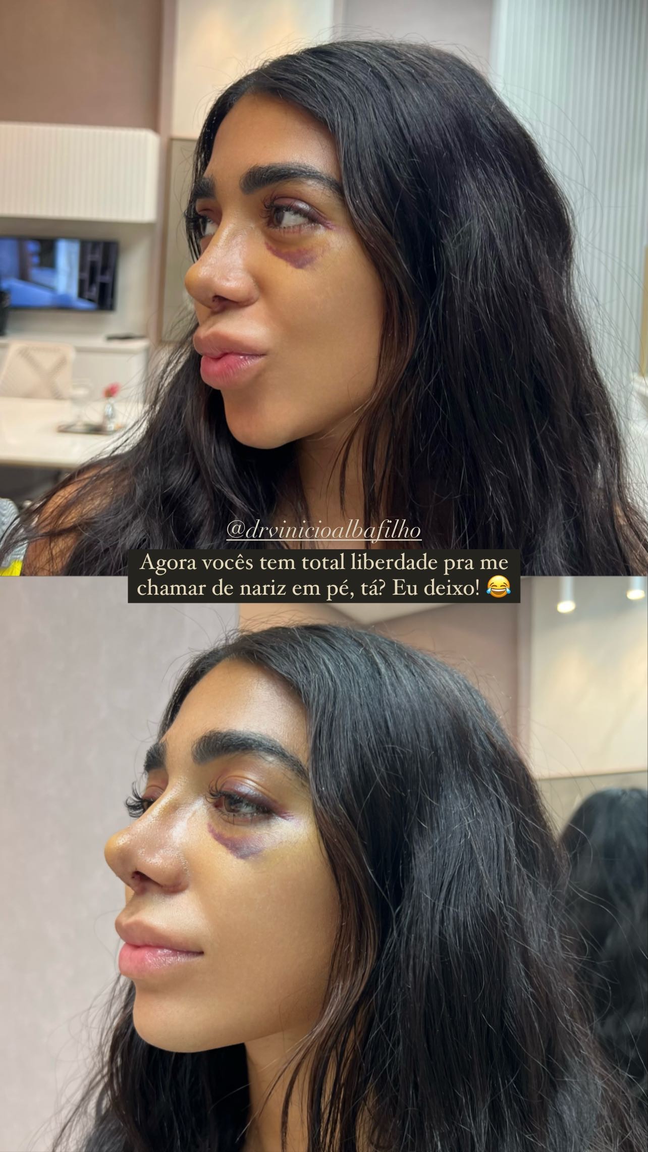 Dhiovanna Barbosa, irmã de Gabigol, mostra nariz após plástica (Foto: Reprodução/Instagram)