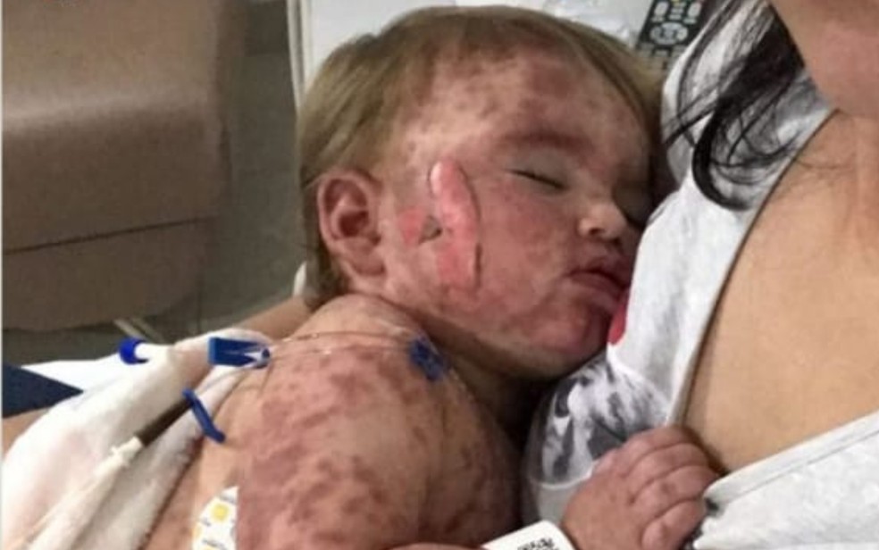 Helena Cristina, 1 ano, após sofrer reação autoimune a medicamento em Anápolis Goiânia Goiás — Foto: Reprodução/Instagram