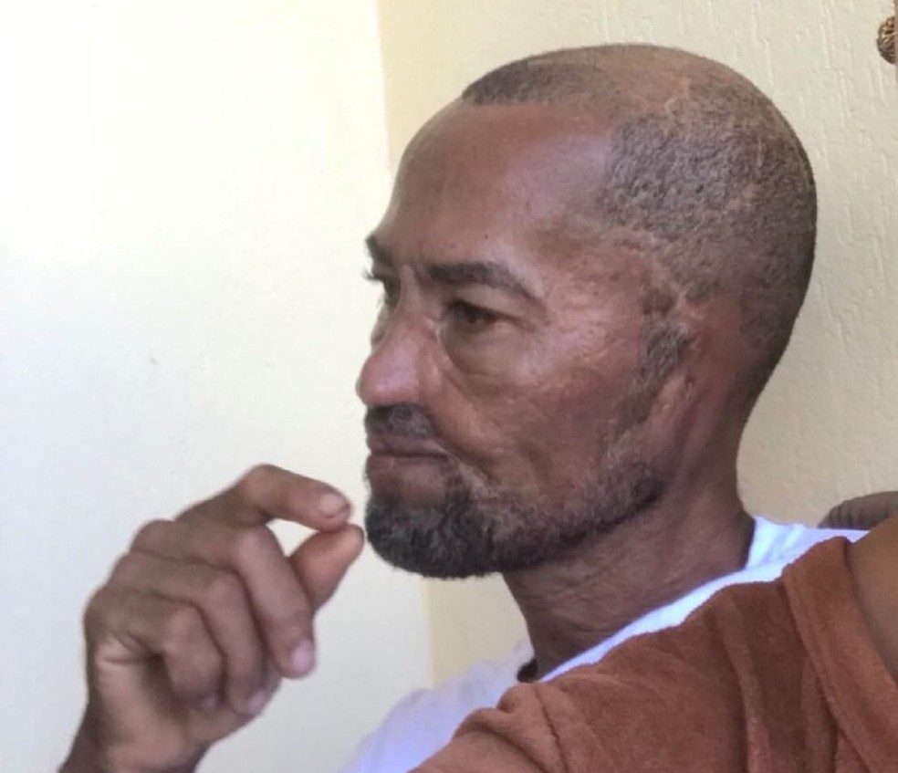 Baiano relata ataque de cães e pede ajuda para realizar cirurgia de reconstrução facial — Foto: Arquivo Pessoal