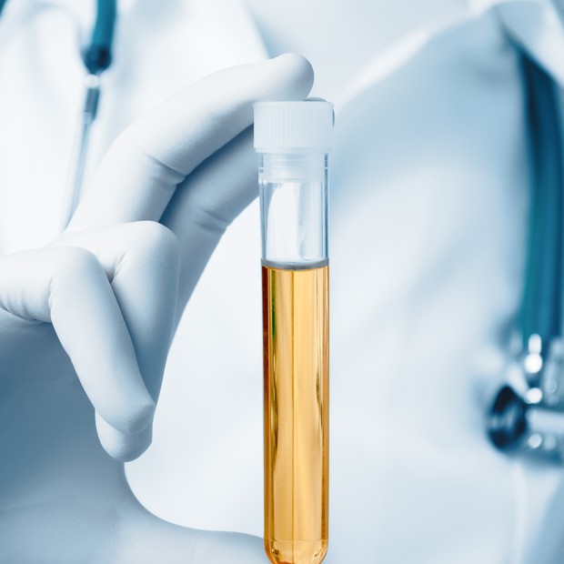 Exame de urina ajuda a detectar câncer de próstata com mais precisão (Foto: Thinkstock)