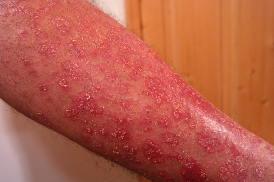 Caso mais grave de psoríase, com lesões bem avermelhadas pelo braço (Foto: Pixabay/Hans/Creative Commons)