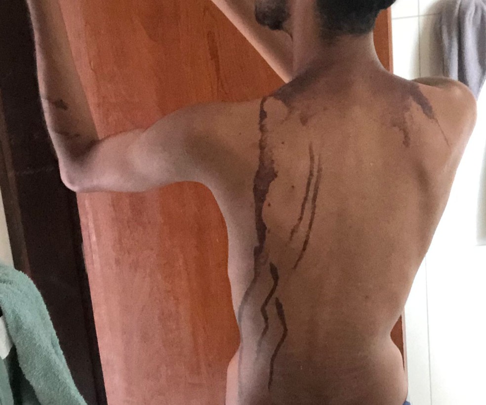 Aluno de 19 anos sofreu queimaduras na nuca e nas costas — Foto: Reprodução