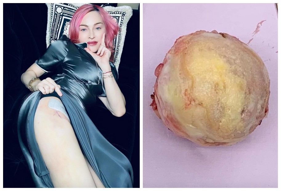 A foto compartilhada por Madonna mostrando o local no qual teria sido operada e a suposta cabeça femoral removida de sua cintura (Foto: Instagram)