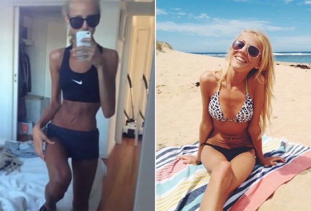 Antes e depois: a australiana Christie Swadling, que chegou a pesar 30 kg (a esq.) e hoje publica sua rotina de exercícios e alimentação saudável (à dir.) (Foto: Reprodução / Facebook)