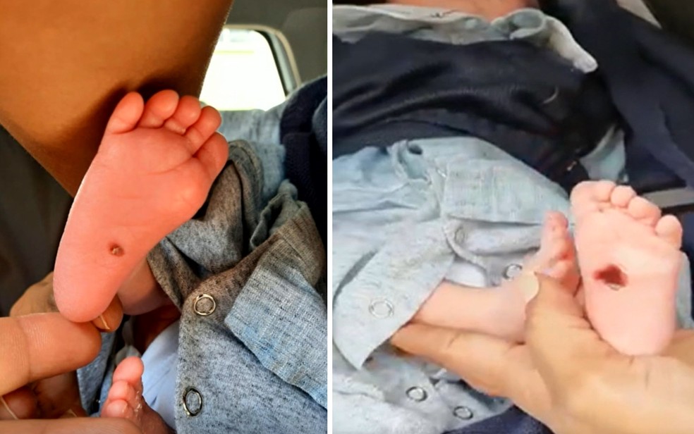 Pais denunciam que bebê teve os pés queimados em incubadora de hospital em Goiânia — Foto: Arquivo pessoal 