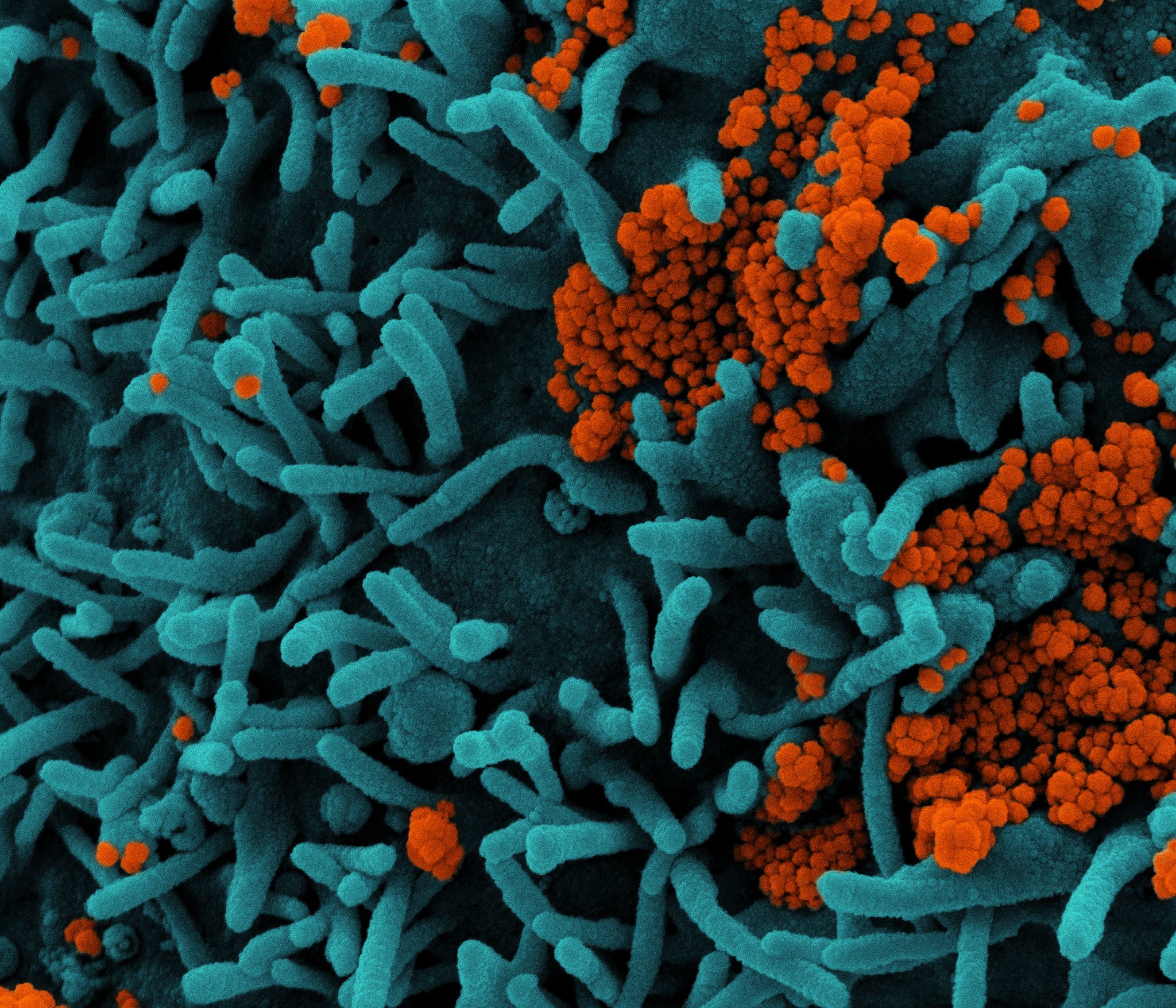 Micrografia eletrônica de varredura colorida de uma célula (azul) infectada com partículas do vírus Sars-CoV-2 (laranja), (Foto: NIAID)