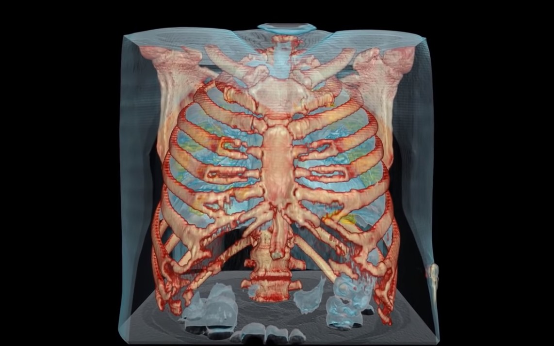 Vídeo mostra danos da Covid-19 em pulmão de paciente infectado (Foto: Hospital da Universidade George Washington)