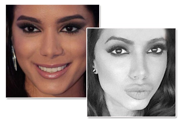 Antes e depois do preenchimento labial de Anitta (Foto: Divulgação/Reprodução Snapchat)