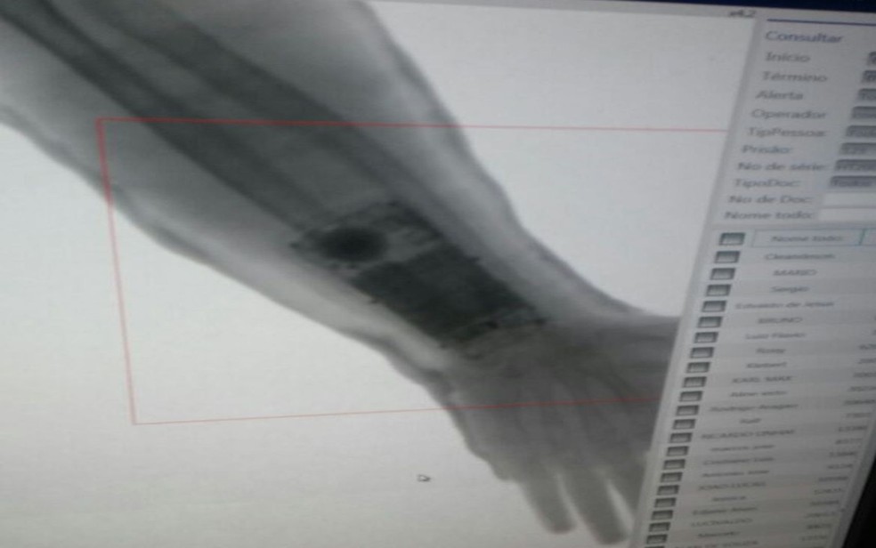 Ao realizar um exame de raio-x foi constatado que um aparelho celular estava dentro do gesso (Foto: PM/DivulgaÃ§Ã£o)