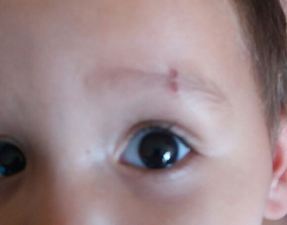 Mordidas foram em várias partes do rosto e das costas (Foto: Arquivo pessoal)