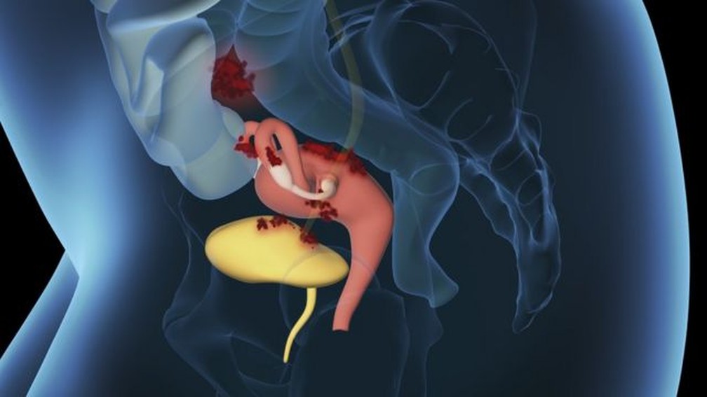 Endometriose ocorre quando um tecido semelhante ao revestimento do útero cresce em outras partes do corpo — geralmente ao redor dos órgãos reprodutivos, intestino e bexiga — Foto: Getty Images/via BBC