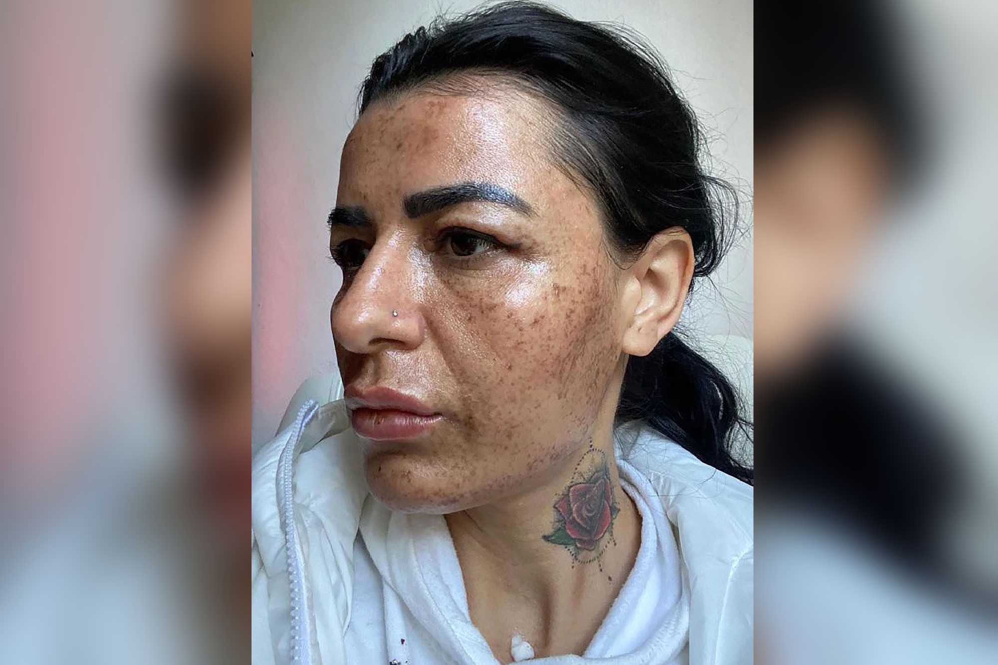 Mulher fica com cicatrizes após esteticista se distrair no celular (Foto: Reprodução/ NY Post)