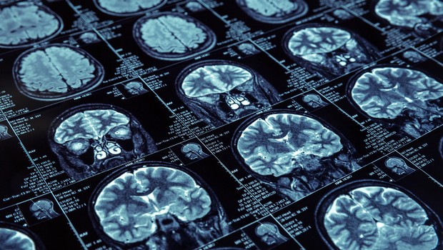 Tomografia do cérebro com contraste visão lateral (Foto: Thinkstock)