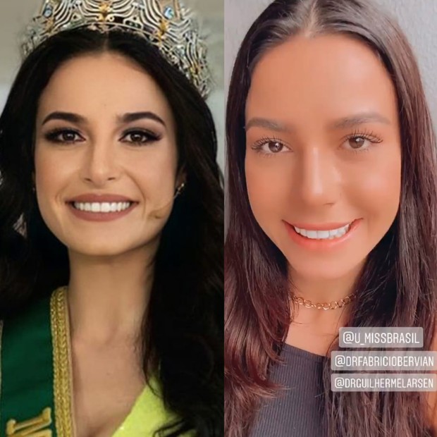Julia Gama, a Miss Brasil 2020, mostra resultado de procedimento no nariz (Foto: Reprodução/Instagram)