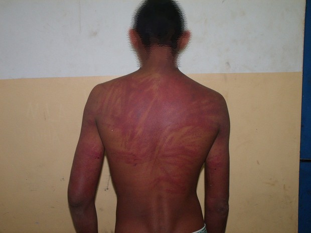 Adolescente de 16 anos exibe marcas de chibatadas nas costas (Foto: Tiago Souza)