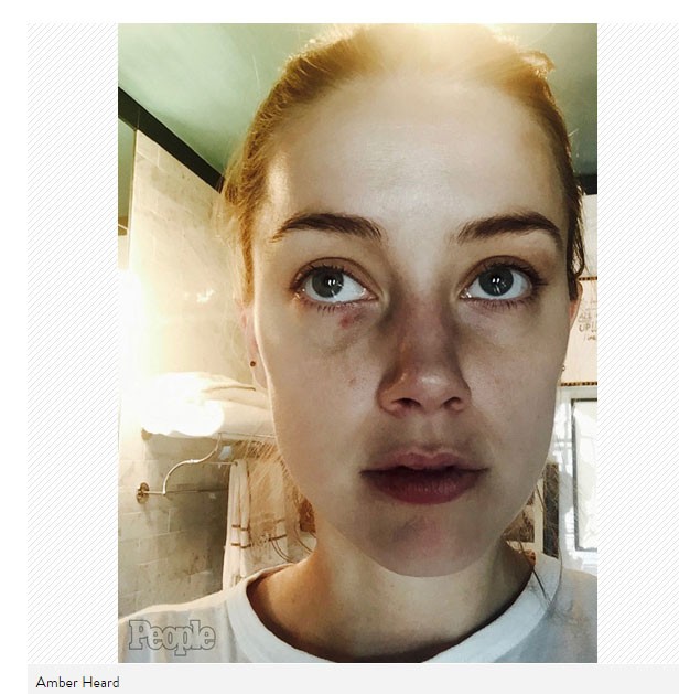 Amber Heard em fotos inéditas de agressão (Foto: Reprodução/People)
