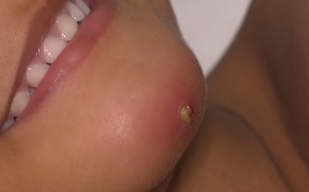 Jordan Miguel tem três anos e foi hospitalizado com lesão semelhante à da mãe, picada por aranha em Salvador — Foto: Reprodução/TV Bahia
