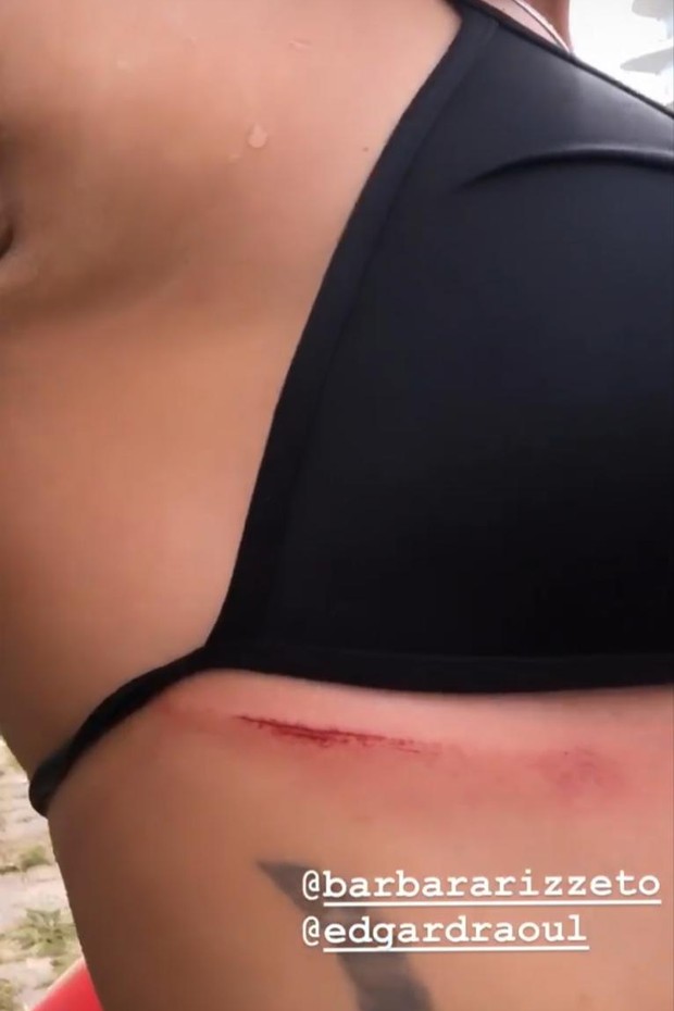 Dani Suzuki mostra machucado pós-surfe (Foto: reprodução/Instagram)