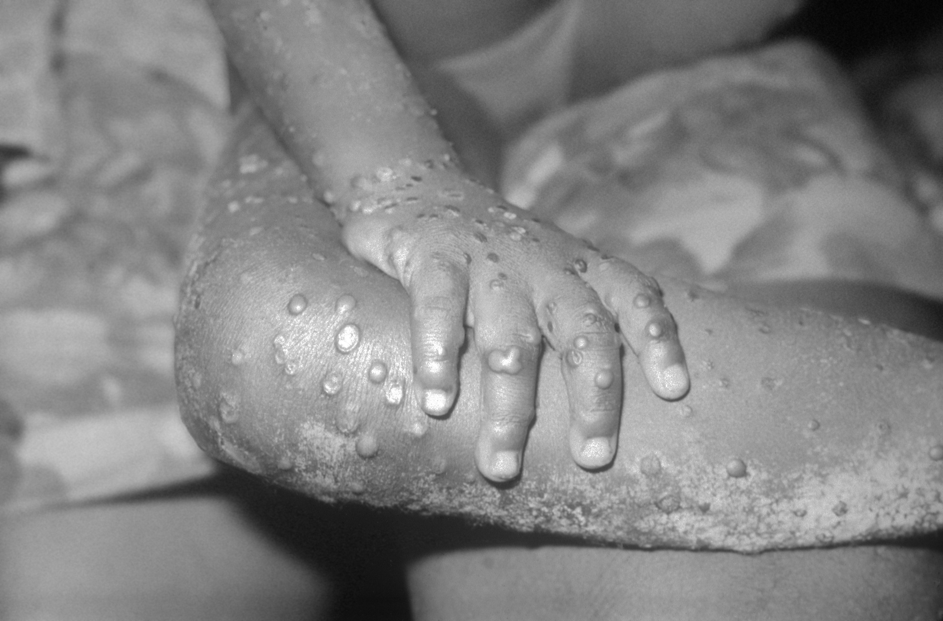 Varíola dos macacos pode causar lesões graves na pele, inclusive nas partes genitais  (Foto: Wikimedia Commons )
