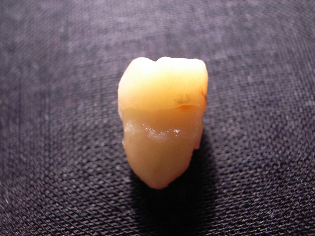 Imagem genérica de um dente (Foto: Toshiyuki IMA/ Wikimedia Commons)