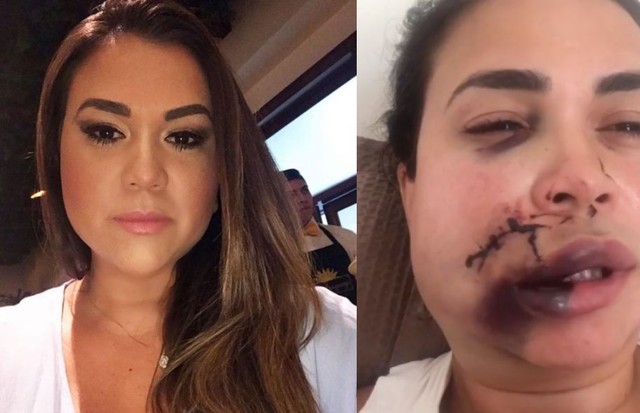 Milka Borges tem rosto desfigurado em agressão dentro de restaurante de luxo e acusa cunhada do dono Fernanda Bonito (Foto: Reprodução/Instagram)