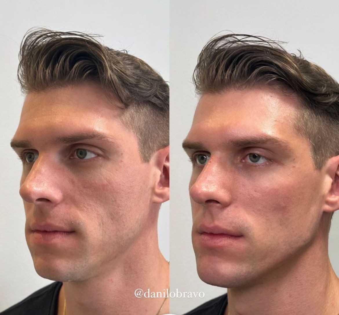 Recentemente, Cristian fez harmonização facial com preenchimento com ácido hialurônico — Foto: Reprpdução/Instagram