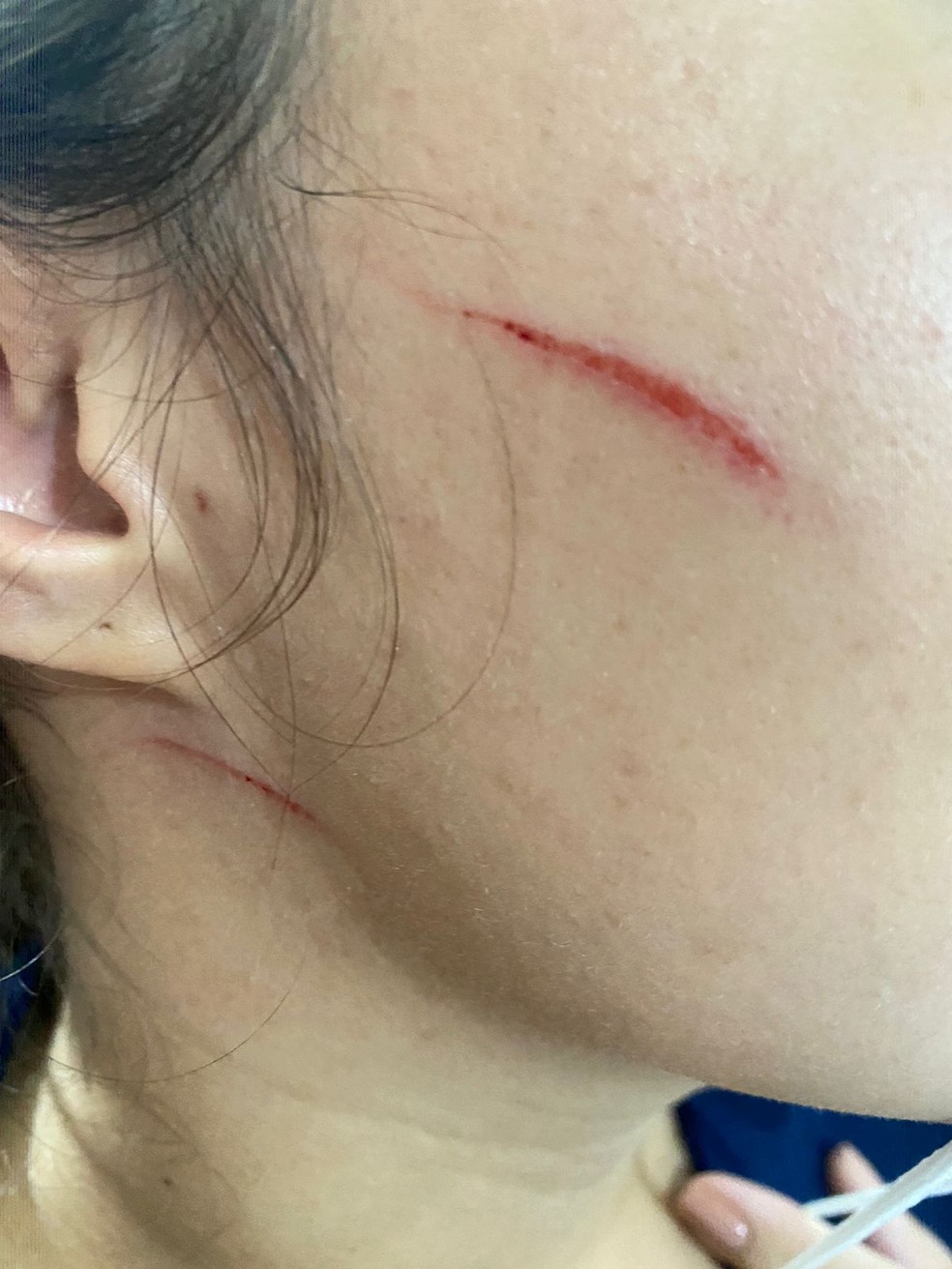 Médica ficou com arranhões no rosto e no pescoço após agressões de mãe de paciente em UPA de Natal — Foto: Kleber Teixeira/Inter TV Cabugi