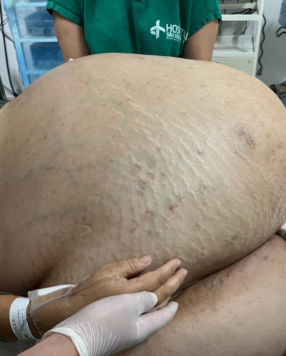 Paciente estava com o tumor há pelo menos 5 anos; mulher é natural de MG mas mora em Itaperuna — Foto: Reprodução/Instagram 