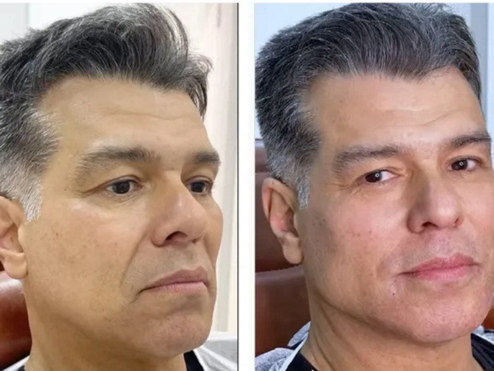 Antes e depois de harmonização facial de Maurício Mattar — Foto: Reprodução/Instagram
