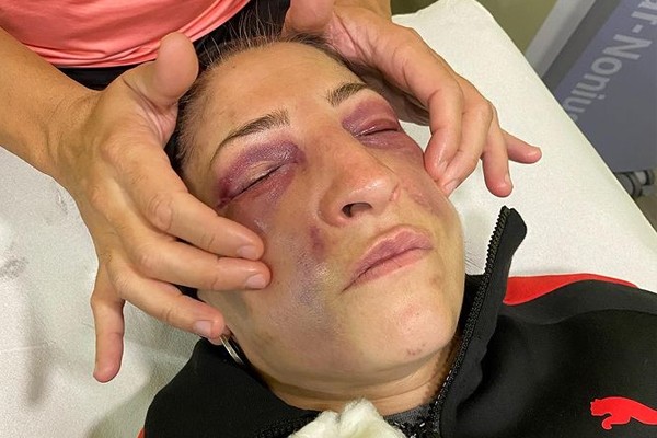 Miriam Gutiérrez está fazendo tratamento depois de enfrentar Amanda Serrano no ringue (Foto: Reprodução / Instagram)