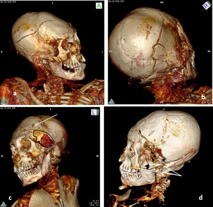 Imagens da tomografia computadorizada 3D, usada para determinar a causa de morte das múmias (Foto: A-M Begerock, R Loynes, OK Peschel, J Verano, R Bianucci, I Martinez Armijo, M González, AG Nerlich)